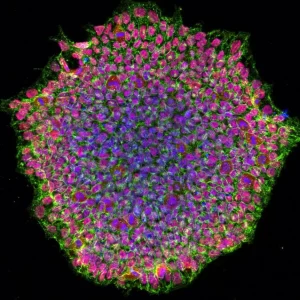 human induced pluripotent stem cell colony from OCA1A patient