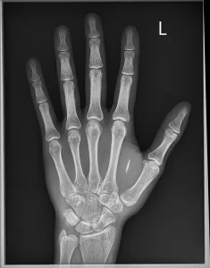 X-Ray DICOM file depicting the PA (posterioranterior) view of an xEM RFID emulator chip from Dangerous things, after installation in the left hand parallel to the 2nd metacarpal bone