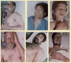 Victims of Iraq's attacks on Sardasht with chemical weapons